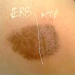 Birthmark9