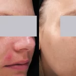 Rosacea Treatment1