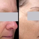 Rosacea Treatment10