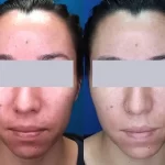 Rosacea Treatment2