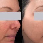 Rosacea Treatment3