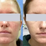 Rosacea Treatment4