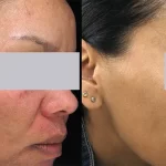 Rosacea Treatment5