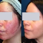 Rosacea Treatment6