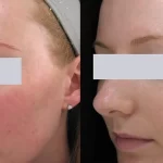 Rosacea Treatment7