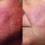 Rosacea Treatment8