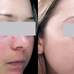 Rosacea Treatment9