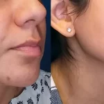 melasma10