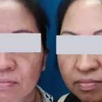 melasma11