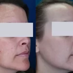 melasma12