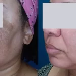 melasma13