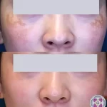 melasma14