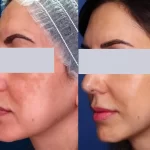 melasma15