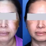 melasma16