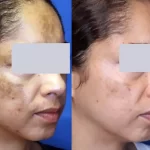 melasma17