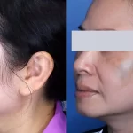 melasma18