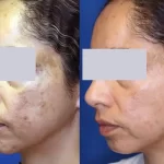 melasma19