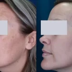 melasma2