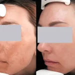 melasma20