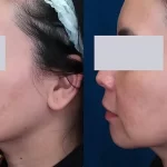 melasma3