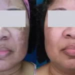 melasma4