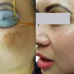 melasma5