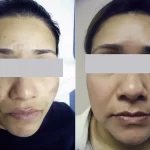 melasma7