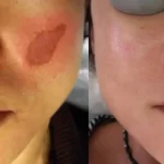 melasma8