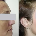 melasma9