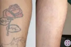 thumbs_TattooRemovalBeforeandAfter01