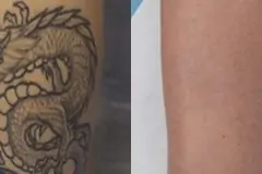 thumbs_TattooRemovalBeforeandAfter02