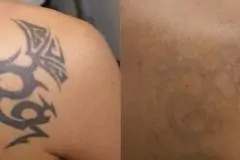 thumbs_TattooRemovalBeforeandAfter03