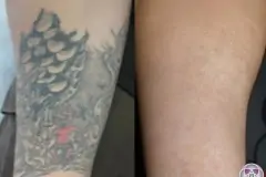 thumbs_TattooRemovalBeforeandAfter05