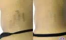 thumbs_laser-stretch-mark-reduction-dark-skin