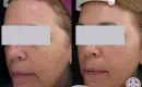 thumbs_laser-treatment-for-dark-spots-female