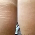 thumbs_stretch-mark-removal-before-after-2